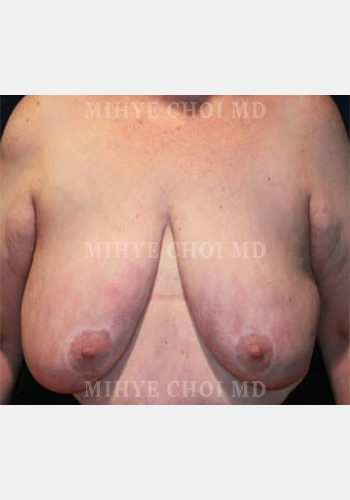 Before Image: Massive Weight Loss Surgery – Case 2 - front