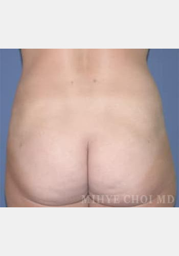 After Image: Liposuction – Case 1 - back