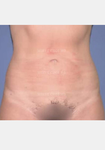 After Image: Liposuction – Case 1 - front