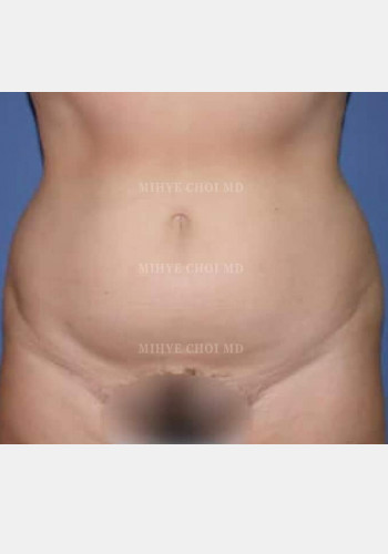 Before Image: Liposuction – Case 1 - front