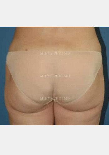 Liposuction – Case 2