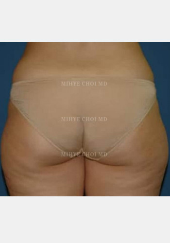 Before Image: Liposuction – Case 2 - back