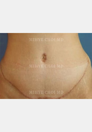 After Image: Abdominoplasty – Case 1 - front