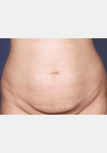 Before Image: Abdominoplasty – Case 1 - front
