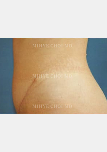 After Image: Abdominoplasty – Case 1 - other