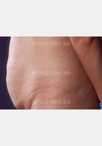 Before Image: Abdominoplasty – Case 1 - other