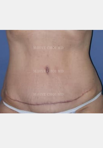 After Image: Abdominoplasty – Case 2 - front
