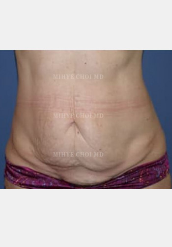Before Image: Abdominoplasty – Case 2 - front