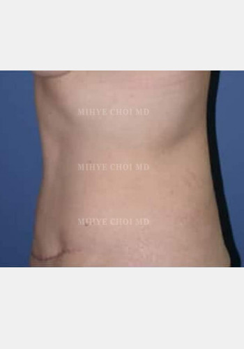 After Image: Abdominoplasty – Case 2 - other