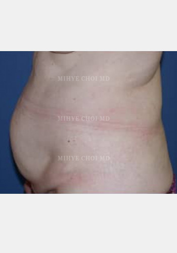 Before Image: Abdominoplasty – Case 2 - other