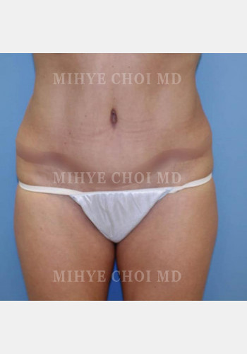 After Image: Abdominoplasty – Case 3 - front