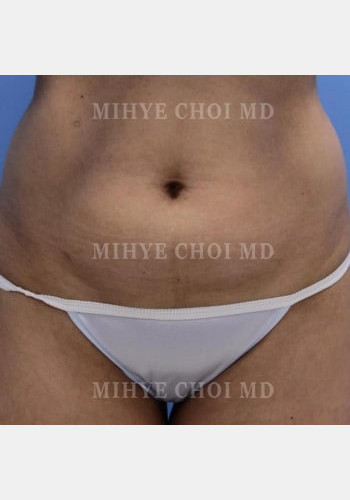 Before Image: Abdominoplasty – Case 3 - front