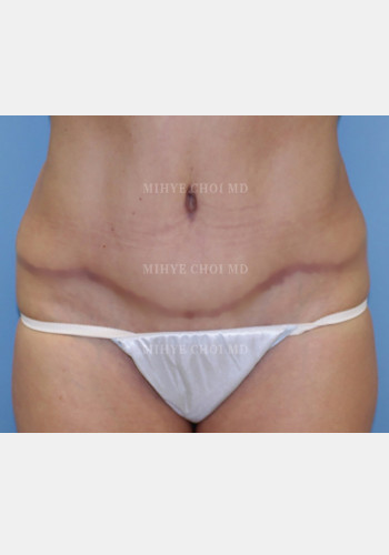After Image: Abdominoplasty – Case 4 - front
