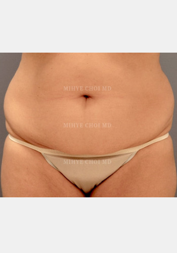 Before Image: Abdominoplasty – Case 4 - front