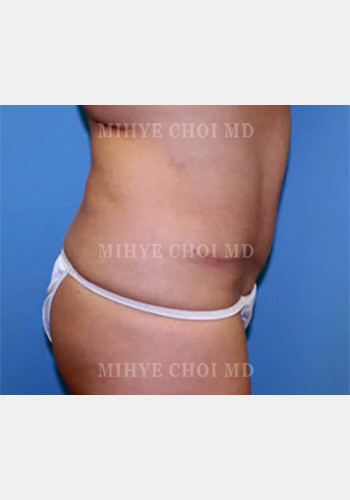After Image: Abdominoplasty – Case 4 - other
