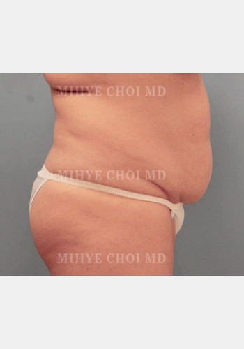 Before Image: Abdominoplasty – Case 4 - other