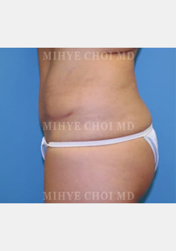 After Image: Abdominoplasty – Case 4 - other