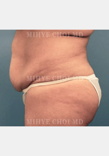 Before Image: Abdominoplasty – Case 4 - other