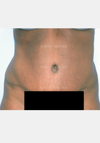 After Image: Abdominoplasty – Case 5 - front