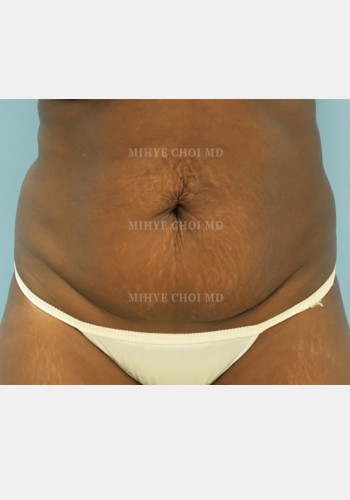 Before Image: Abdominoplasty – Case 5 - front
