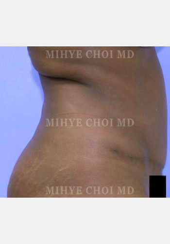 After Image: Abdominoplasty – Case 5 - other