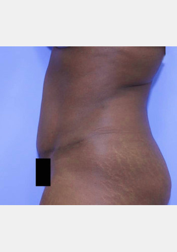After Image: Abdominoplasty – Case 5 - other
