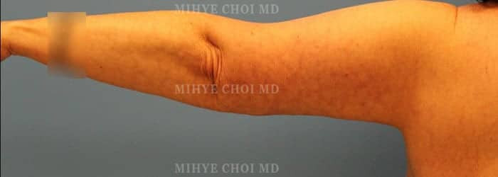 After Image: Brachioplasty Case 1 - left-side