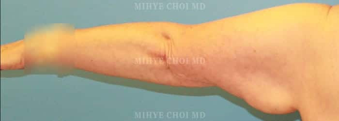 Before Image: Brachioplasty Case 1 - left-side