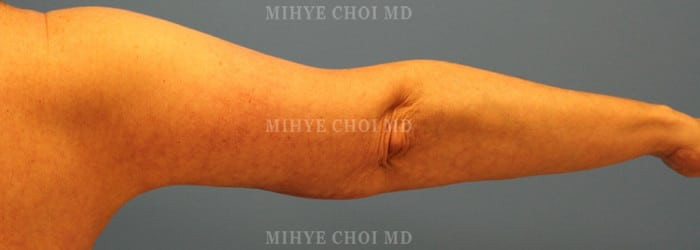 After Image: Brachioplasty Case 1 - right-side