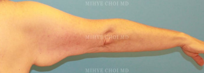 Before Image: Brachioplasty Case 1 - right-side