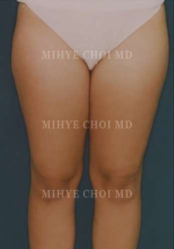 Before Image: Liposuction Case 3 - front