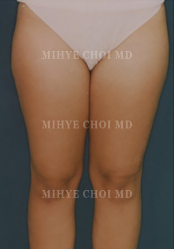 Liposuction Case 3