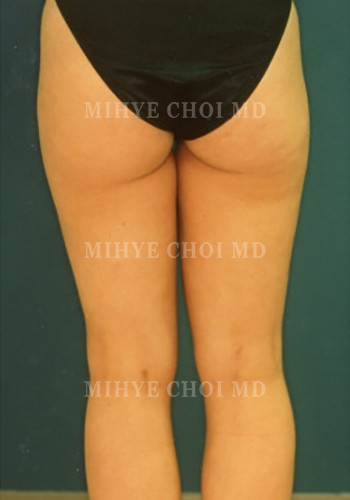 After Image: Liposuction Case 3 - back