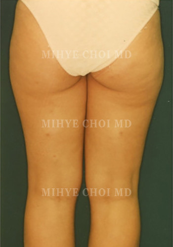 Before Image: Liposuction Case 3 - back