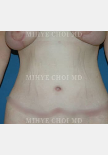 After Image: Massive Weight Loss Surgery – Case 1 - front