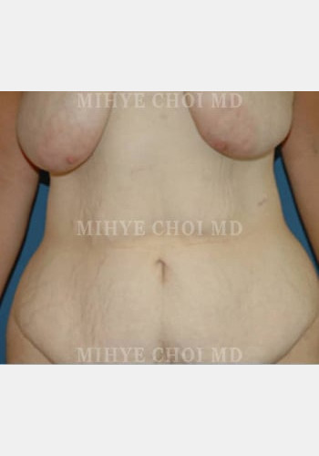Before Image: Massive Weight Loss Surgery – Case 1 - front