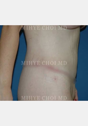 After Image: Massive Weight Loss Surgery – Case 1 - right-side