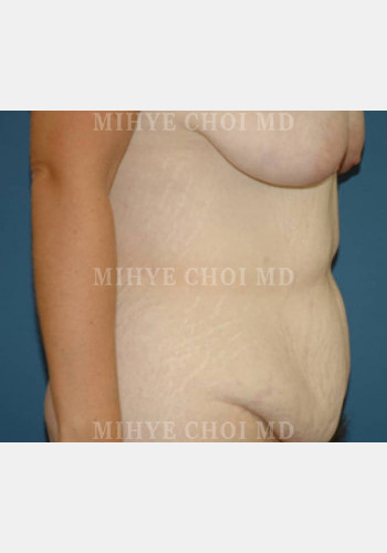 Before Image: Massive Weight Loss Surgery – Case 1 - right-side
