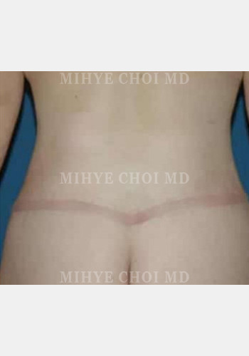 After Image: Massive Weight Loss Surgery – Case 1 - back