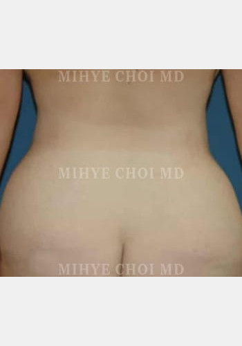Before Image: Massive Weight Loss Surgery – Case 1 - back