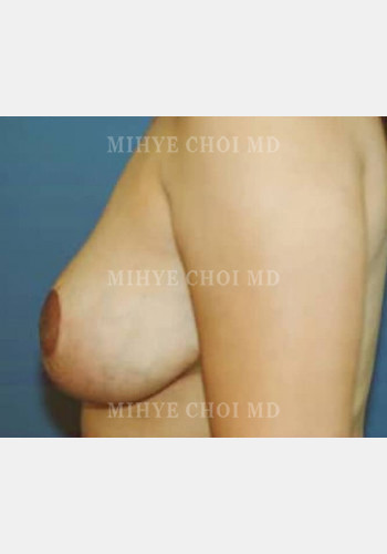 After Image: Breast Reduction – Case 1 - other