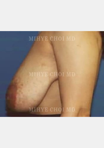 Before Image: Breast Reduction – Case 1 - other