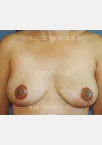After Image: Breast Reduction – Case 1 - front
