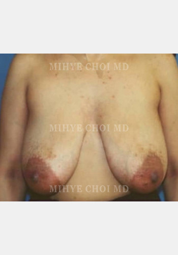 Before Image: Breast Reduction – Case 1 - front