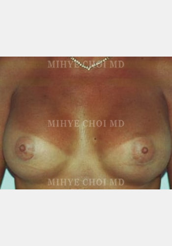 After Image: Breast Augmentation – Case 1 - front