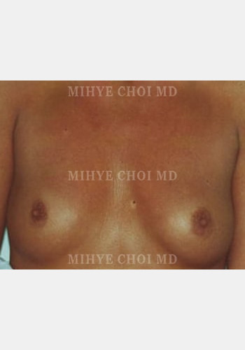 Before Image: Breast Augmentation – Case 1 - front