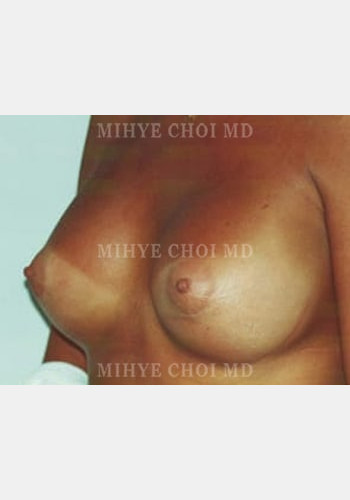 After Image: Breast Augmentation – Case 1 - left-front-oblique