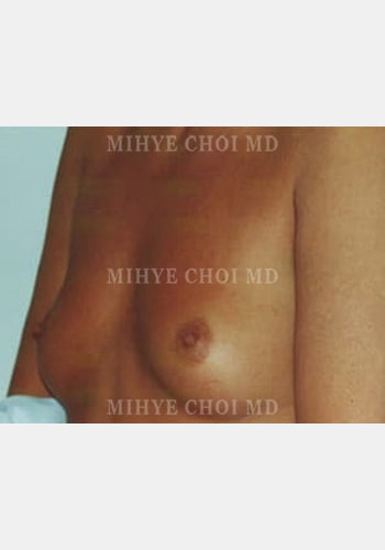 Before Image: Breast Augmentation – Case 1 - left-front-oblique
