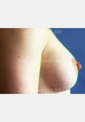 After Image: Breast Augmentation – Case 2 - other