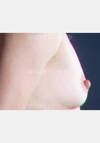 Before Image: Breast Augmentation – Case 2 - other